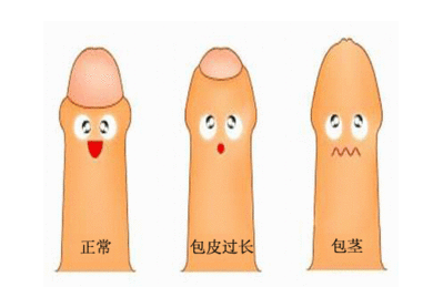 上海男性怎样算包皮过长