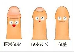 上海包茎和包皮过长的区别